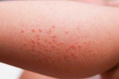 red itchy bumps on forearm