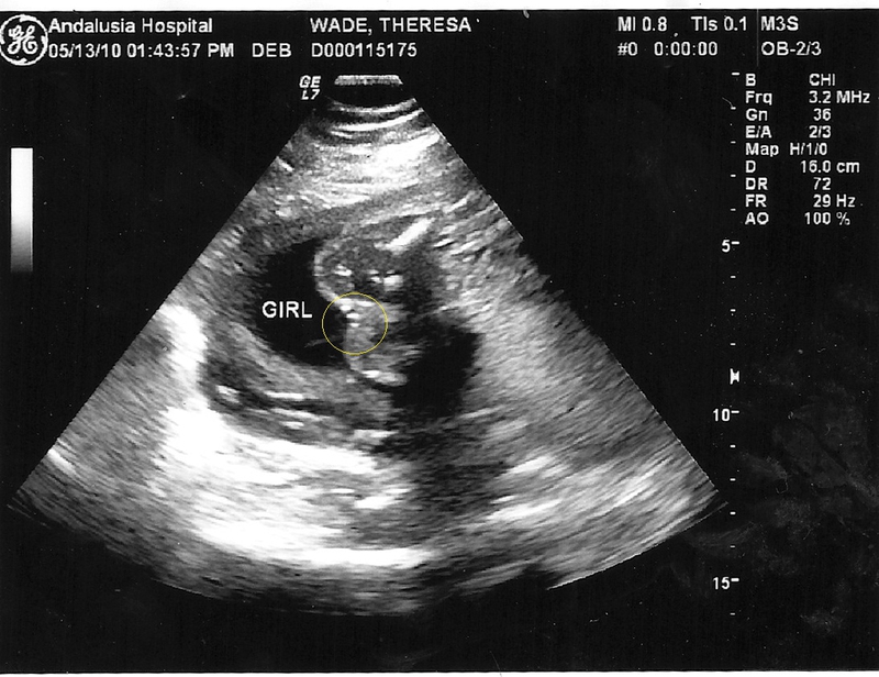 how to know the gender of baby in scan report