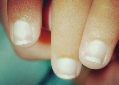Why Is the White Part of My Nails Spreading? - enkimd