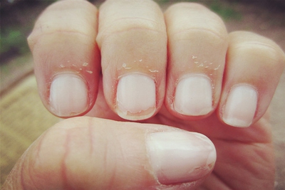 Dry Skin Around Your Nail Causes And Tips To Help Enkimd